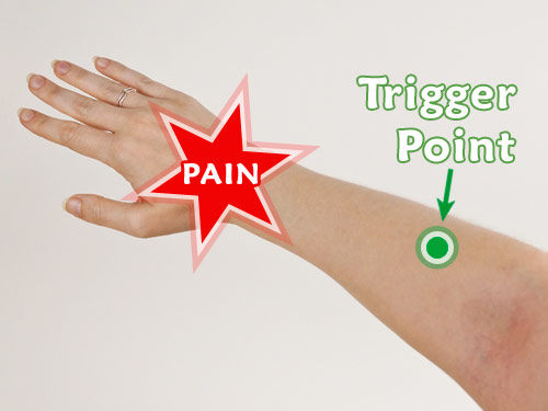 Treating hand and wrist pain with trigger point pressure therapy on the upper forearm